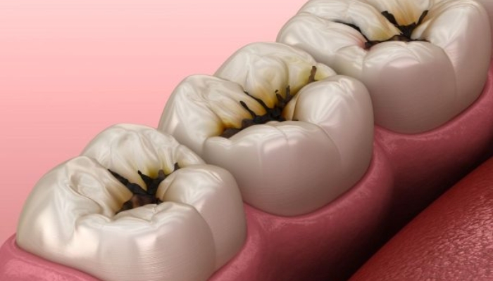 Một số trường hợp có thể xảy ra nếu không xử lý răng khôn kịp thời