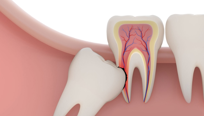 Tại sao phải loại bỏ răng khôn ra khỏi hàm?